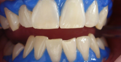 Os 4 Principais Tipos de Clareamentos Dentais que Existem